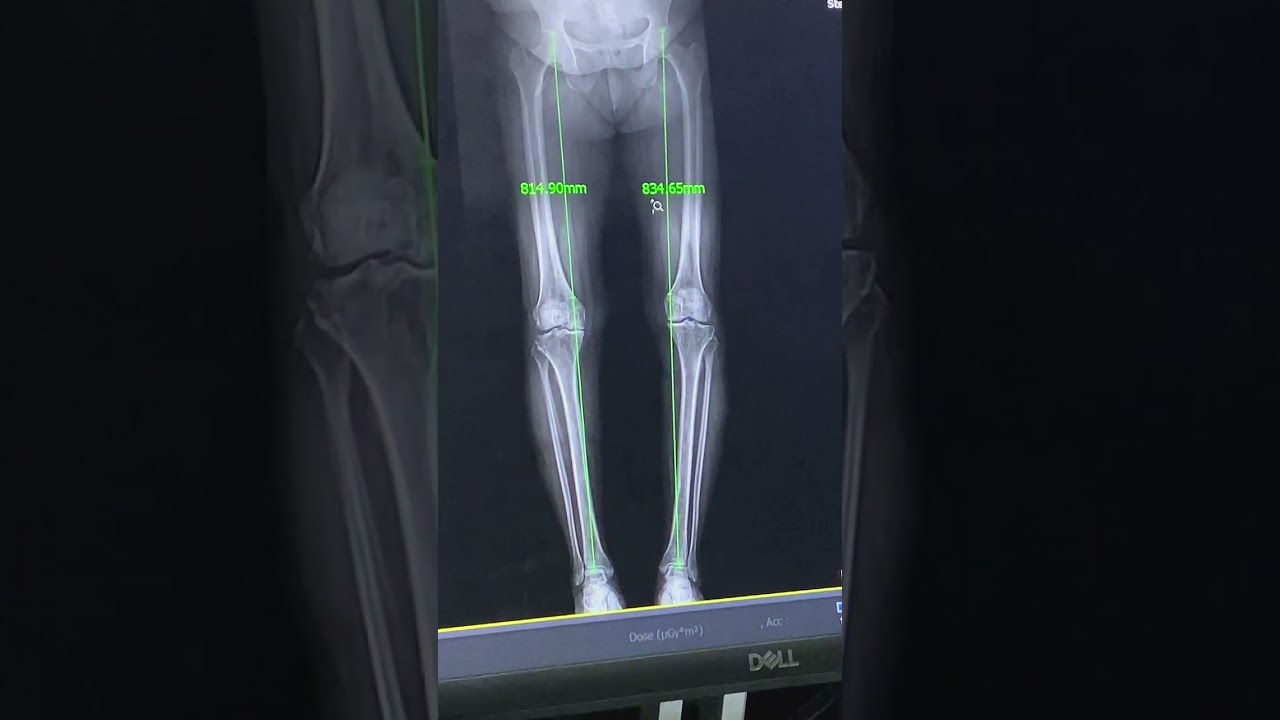 Post processing Standing Full length x.ray lower limb طريقة تكوين وقياس الزوايا الجزء الثاني 