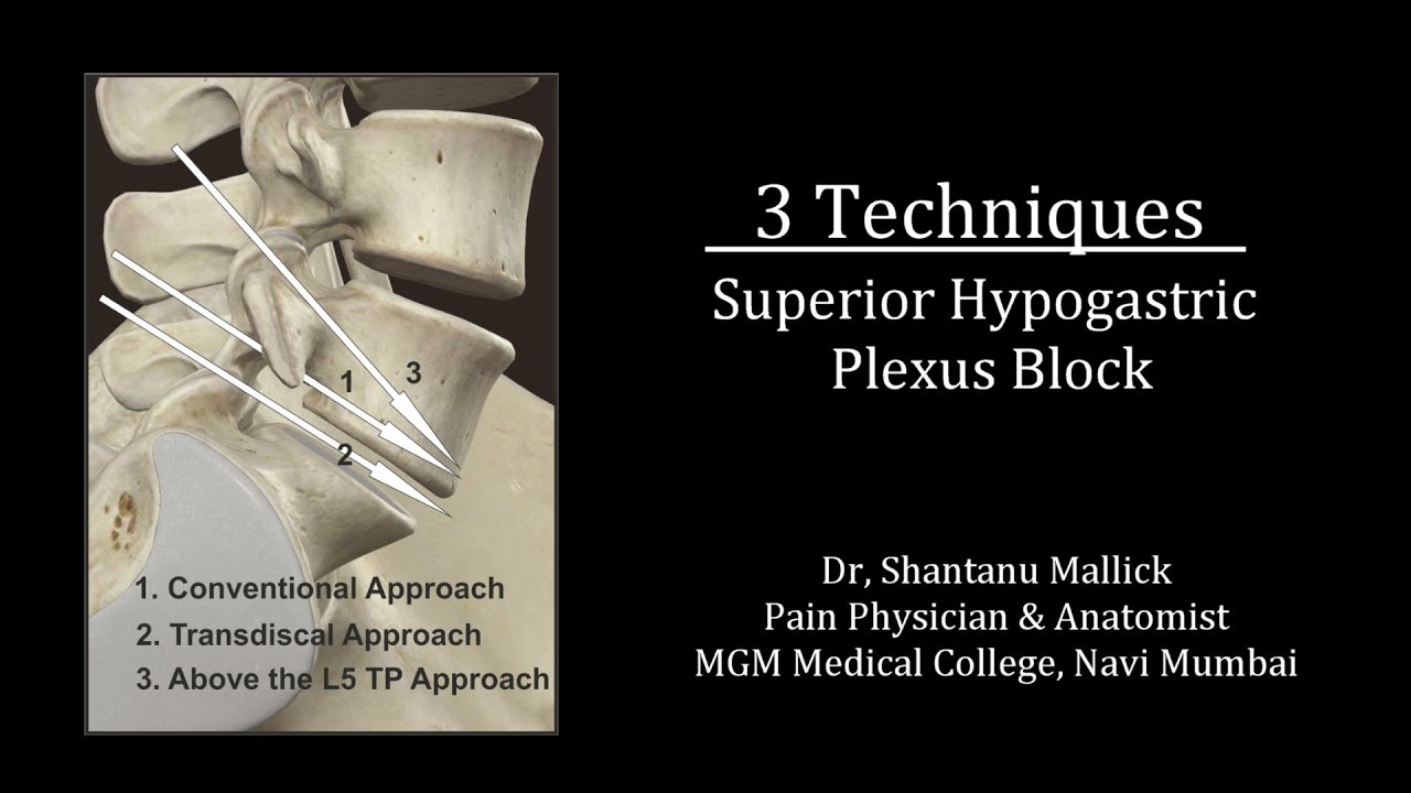 Superior Hypogastric Plexus Block (3 Techniques)