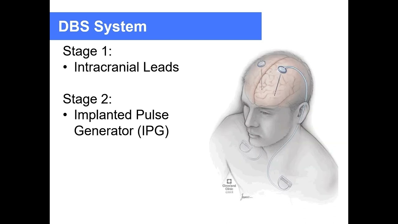 CNS Neurosurgery 100: Parkinson's Disease