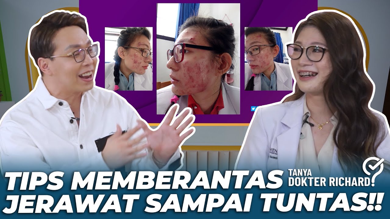 BEGINI TIPS BERANTAS JERAWAT SAMPAI TUNTAS!!