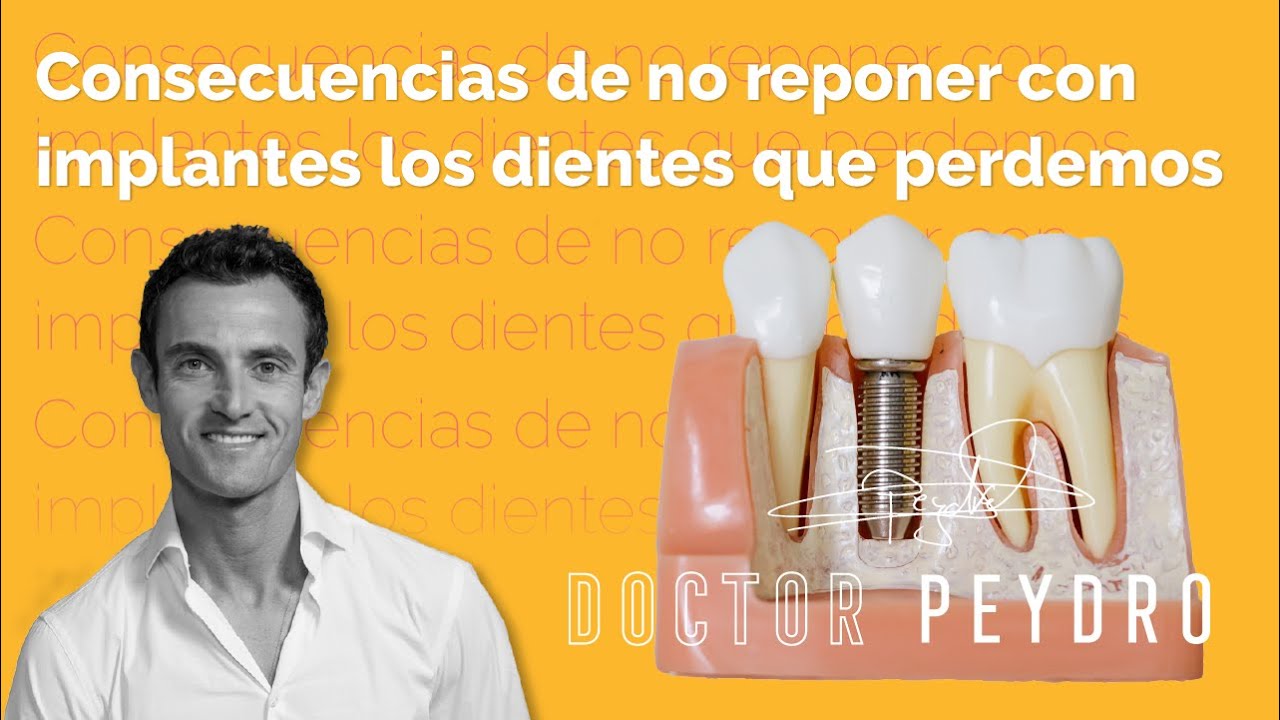 Casos imposibles con IMPLANTES DENTALES. ¿Existen?