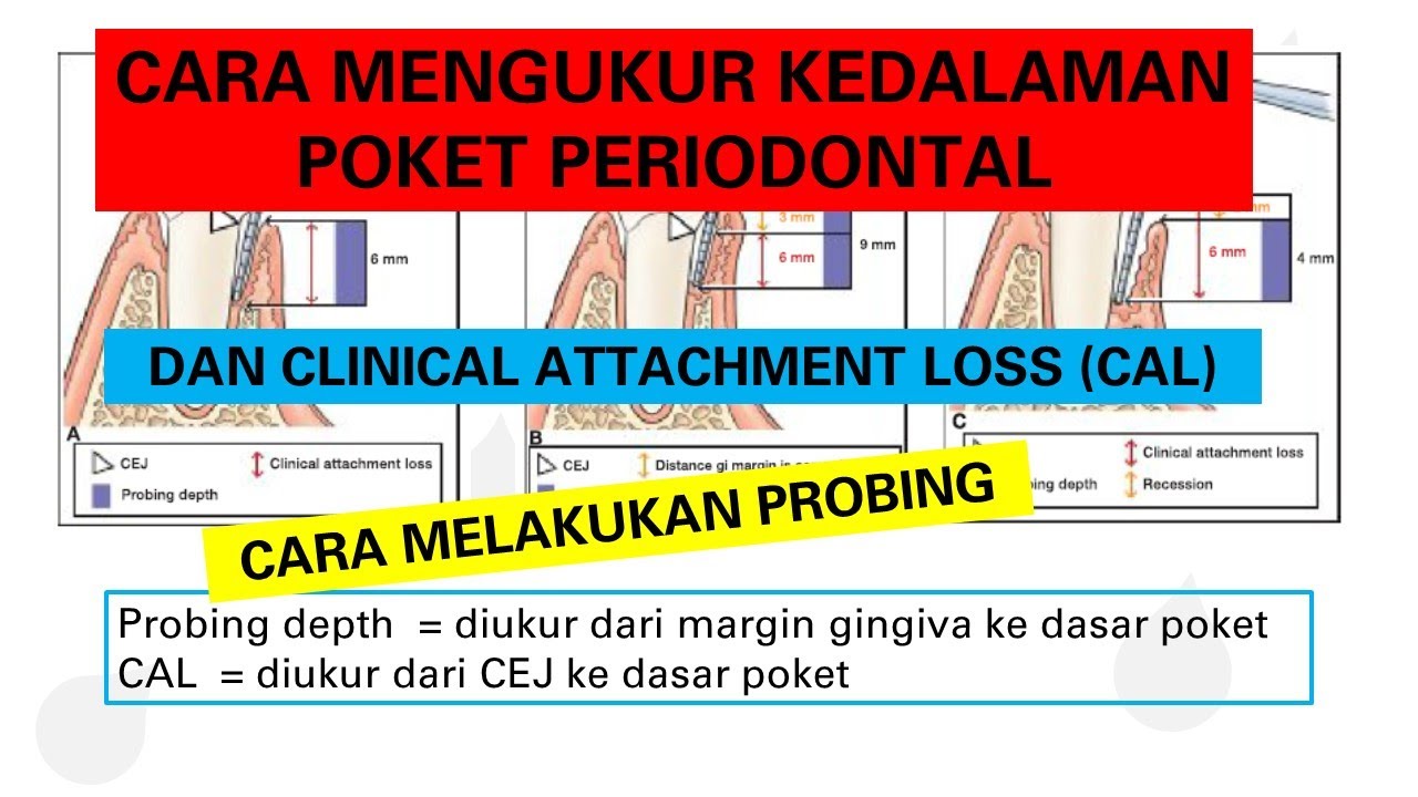 Cara mengukur kedalaman poket periodontal dan Clinical attachment loss (CAL) | Dokter Gigi Channel