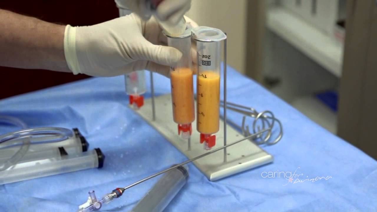 Fat Transfer for Hands