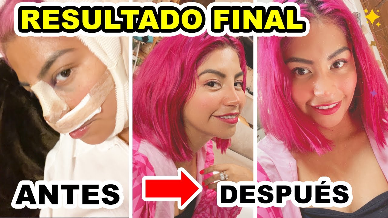 ♥️RESULTADO FINAL DE MI CIRUGÍA DE NARIZ💕 ¡LA AMO! 🙋🏻‍♀️ |Conny Merlin