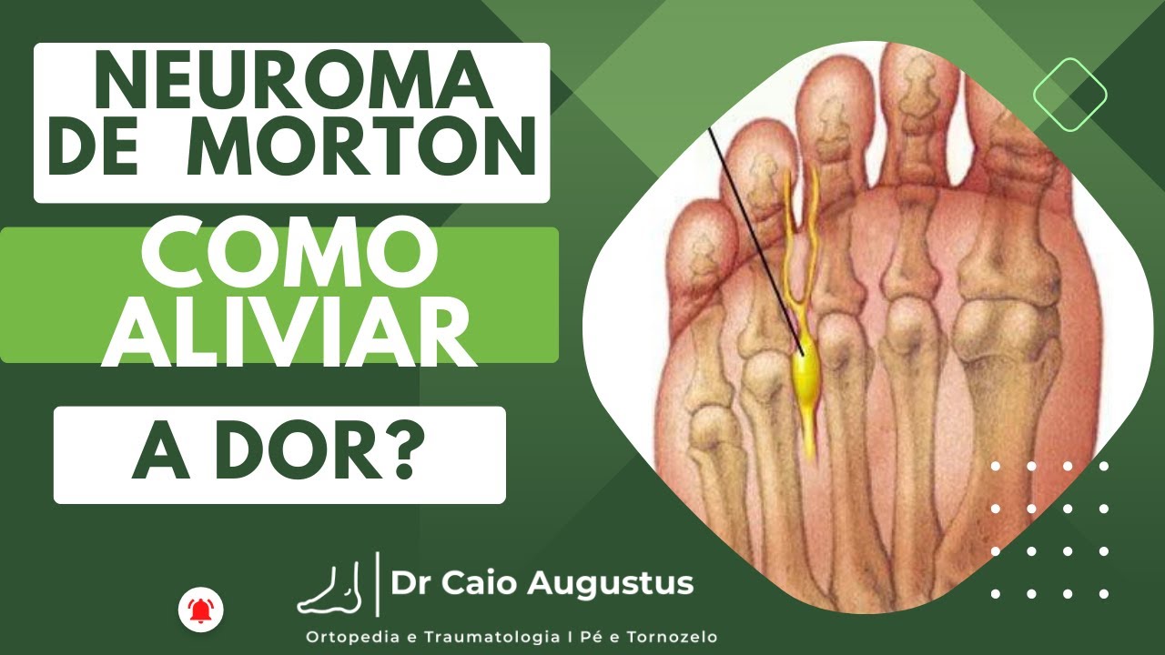 Neuroma de Morton...como aliviar a dor?