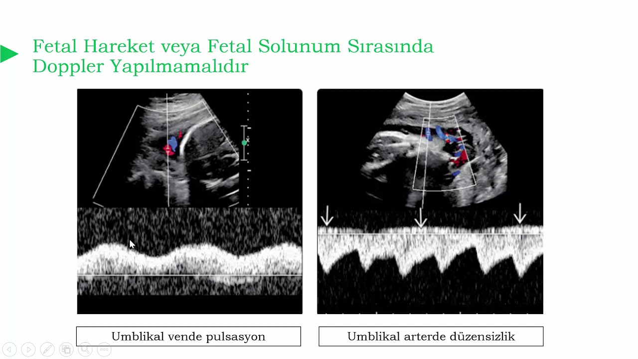 Umblikal Arter Doppler