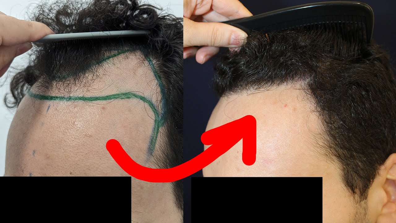TU TIPO de PELO y el RESULTADO del INJERTO de PELO