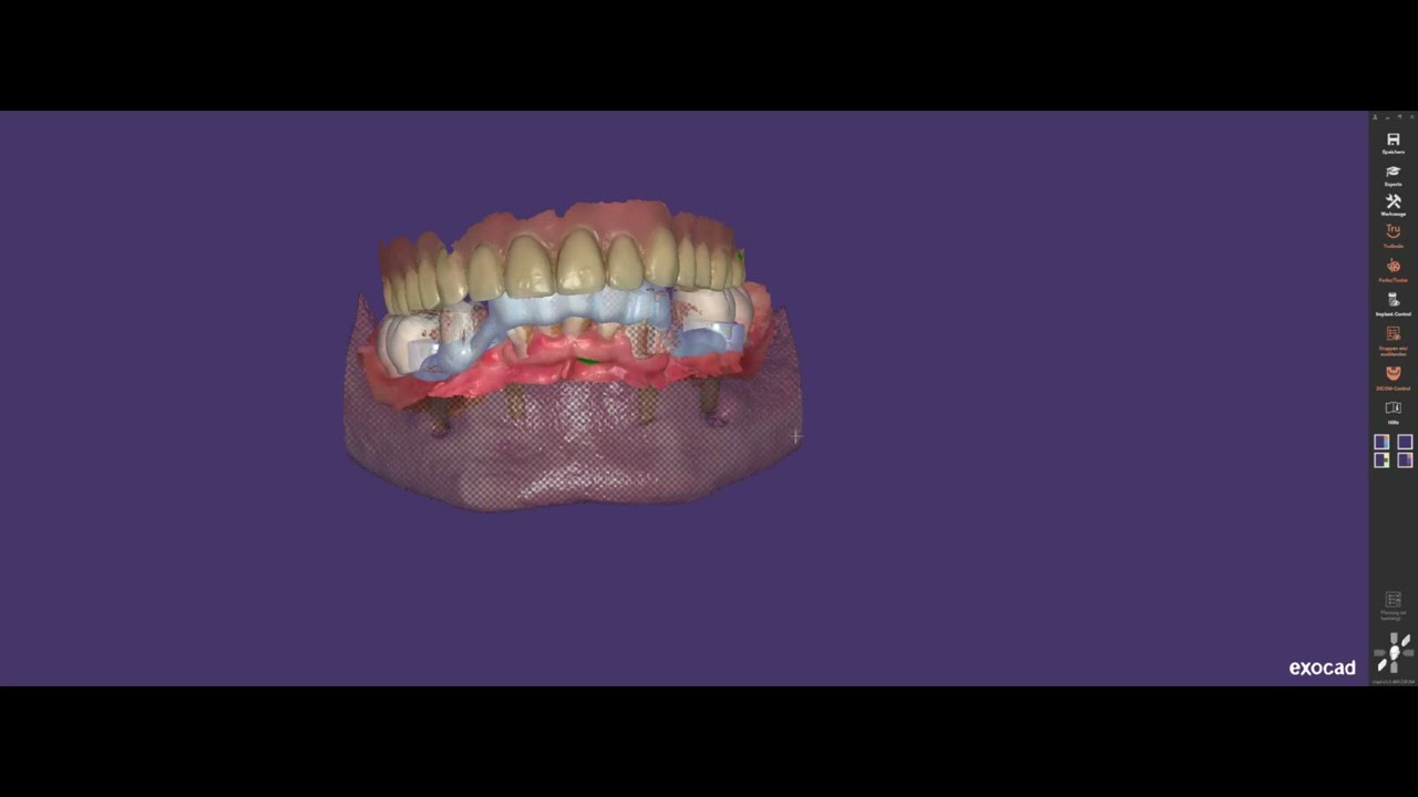 Vollnavigierte Implantatplanung eines zahnlosen Unterkiefers