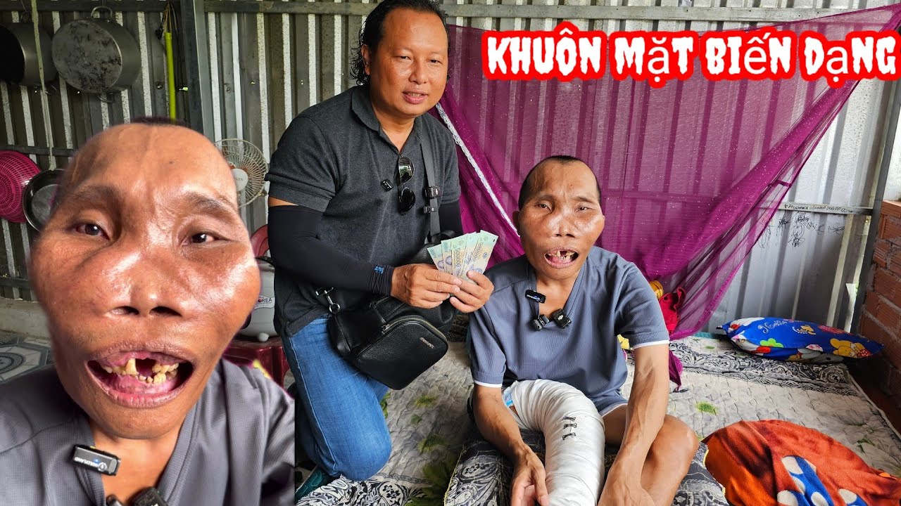Xuất hiện Chàng trai có khuôn Mặt biến d.ạng  bán vé số nuôi Mẹ 