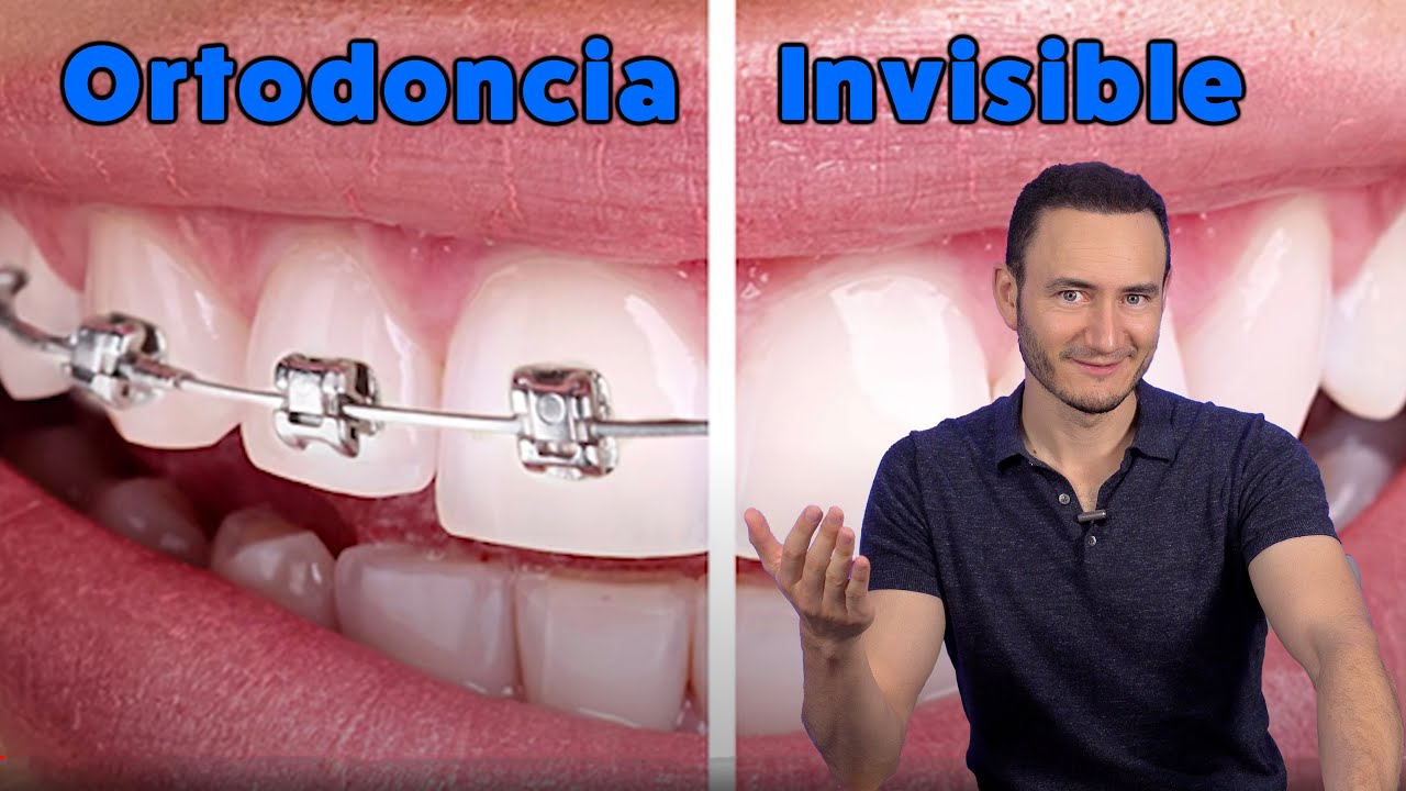 ORTODONCIA CON GUARDAS INVISALIGN | Sin Brackets | Querétaro