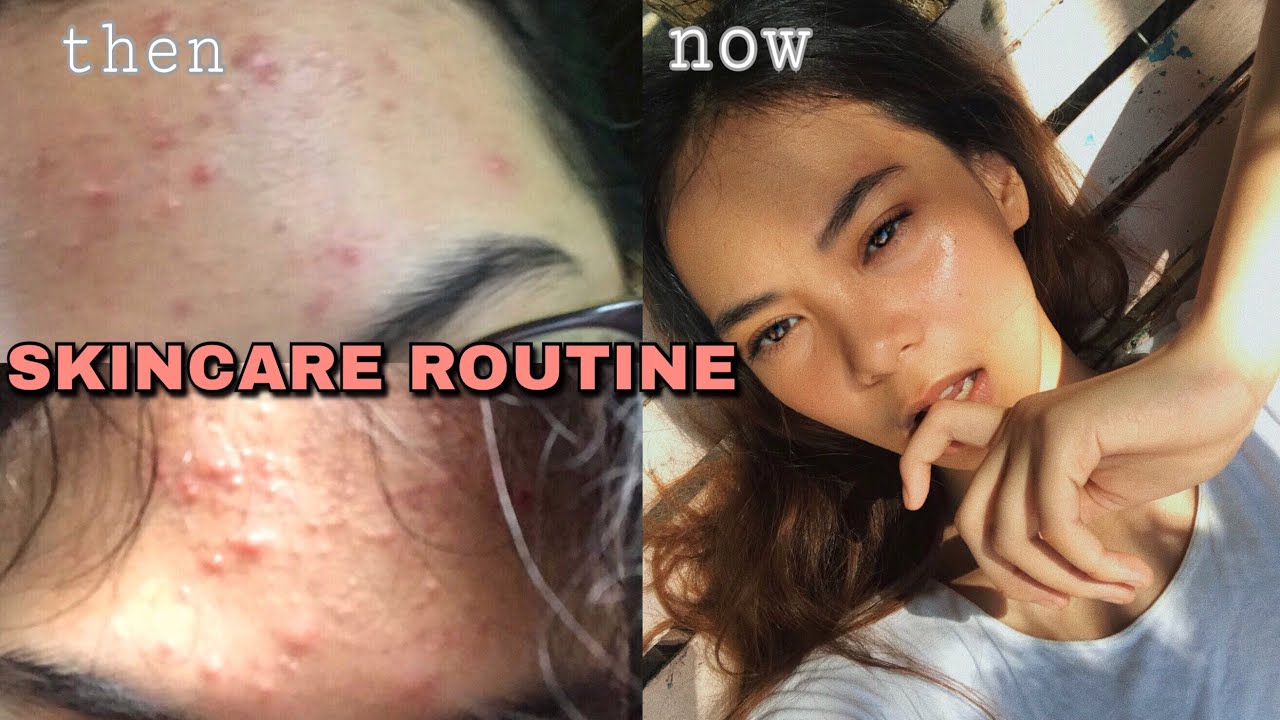HOW I LOST MY PIMPLES IN 1 MONTH + my acne story | Amelia Salve