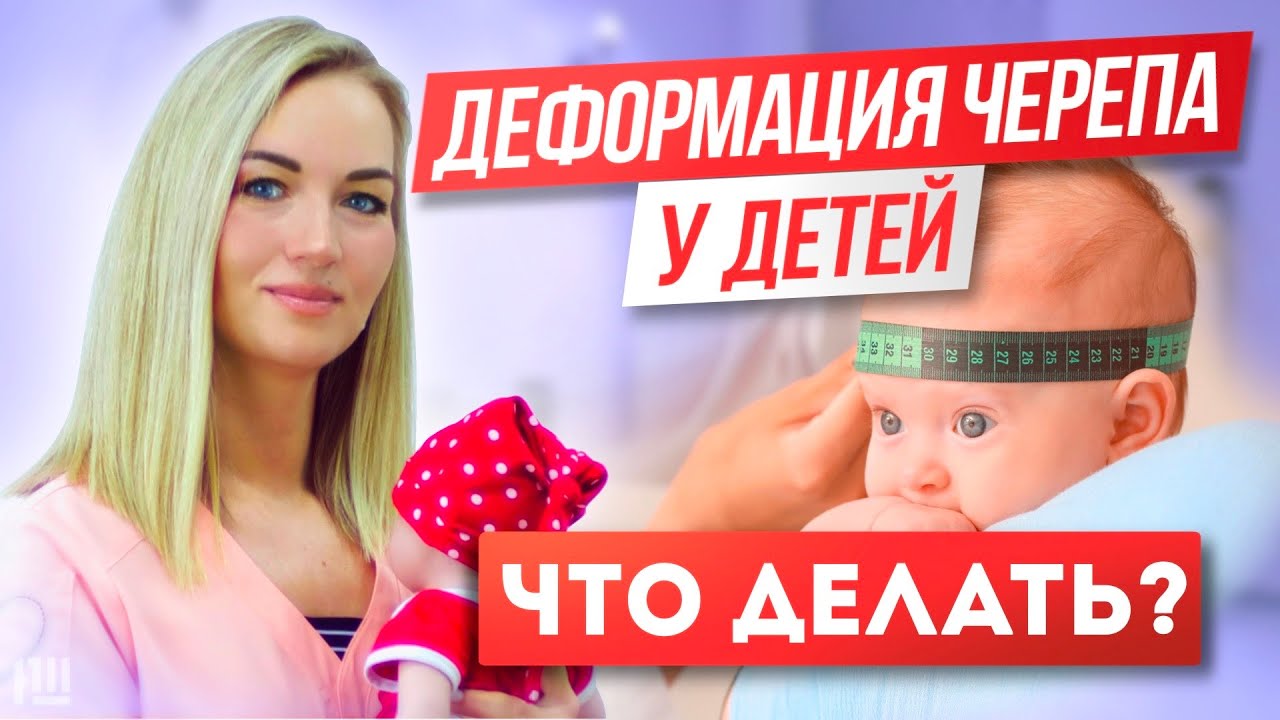 Деформация черепа у ДЕТЕЙ. Можно ли ИСПРАВИТЬ?