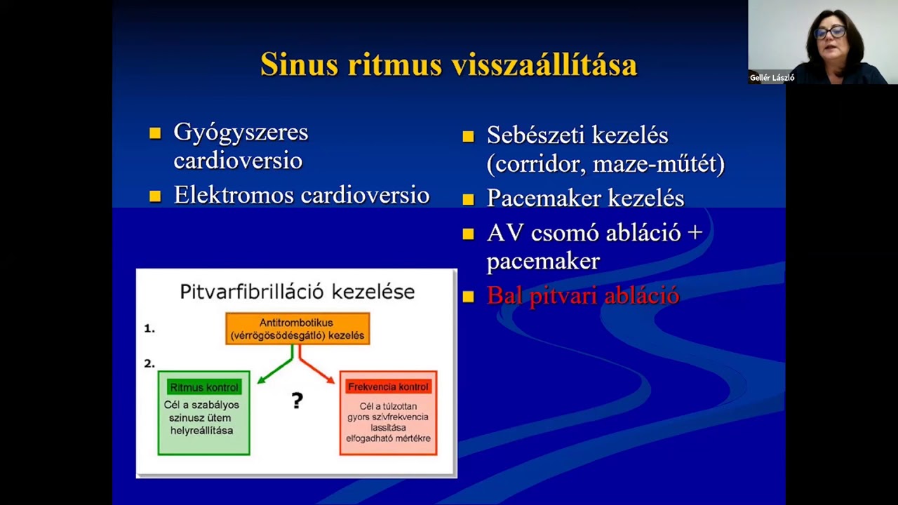 Középpontban a pitvarfibrilláció!  - Srej Marianna előadása