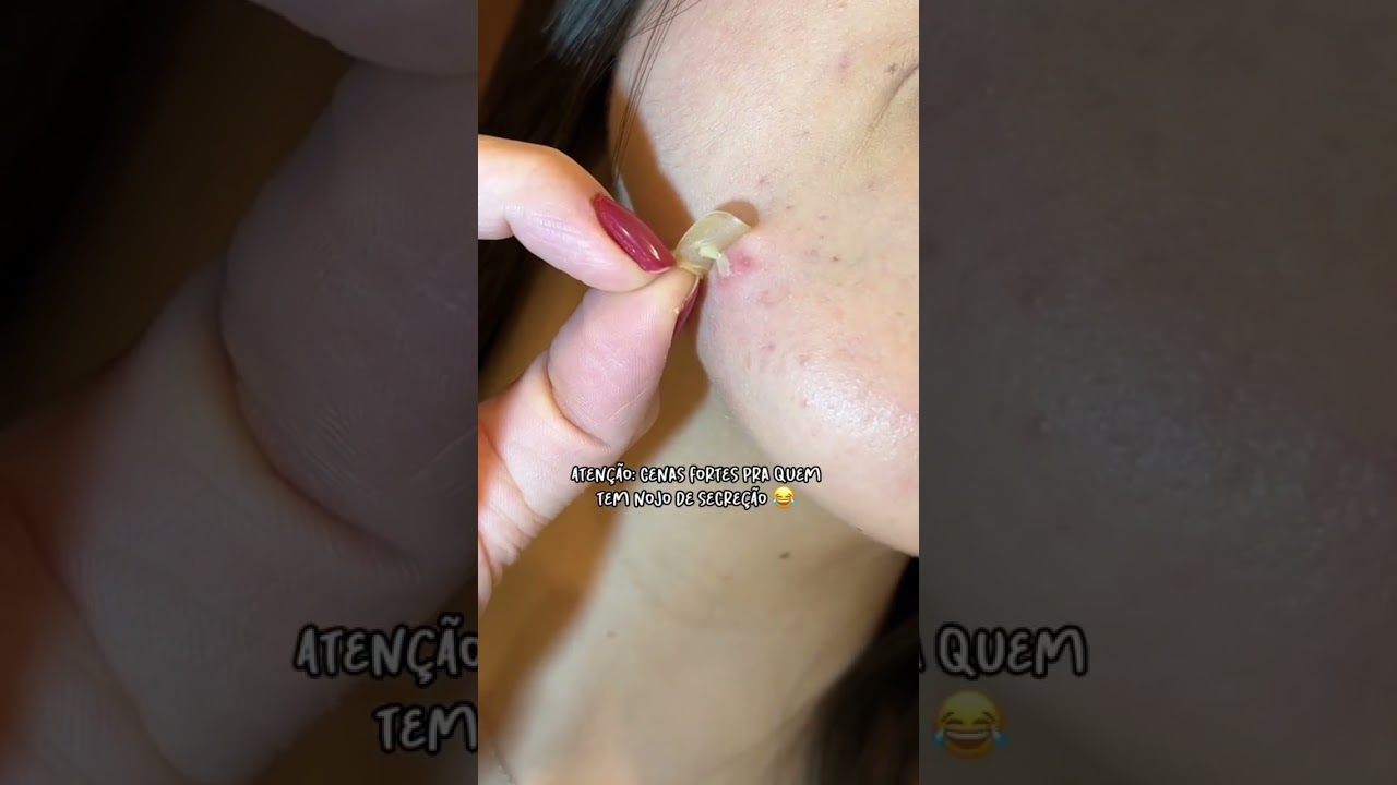 Descubra o poder dos adesivos hidrocoloides contra as espinhas e como voc&ecirc; pode us&aacute;-las💆🧑&zwj;⚕️&hearts;️