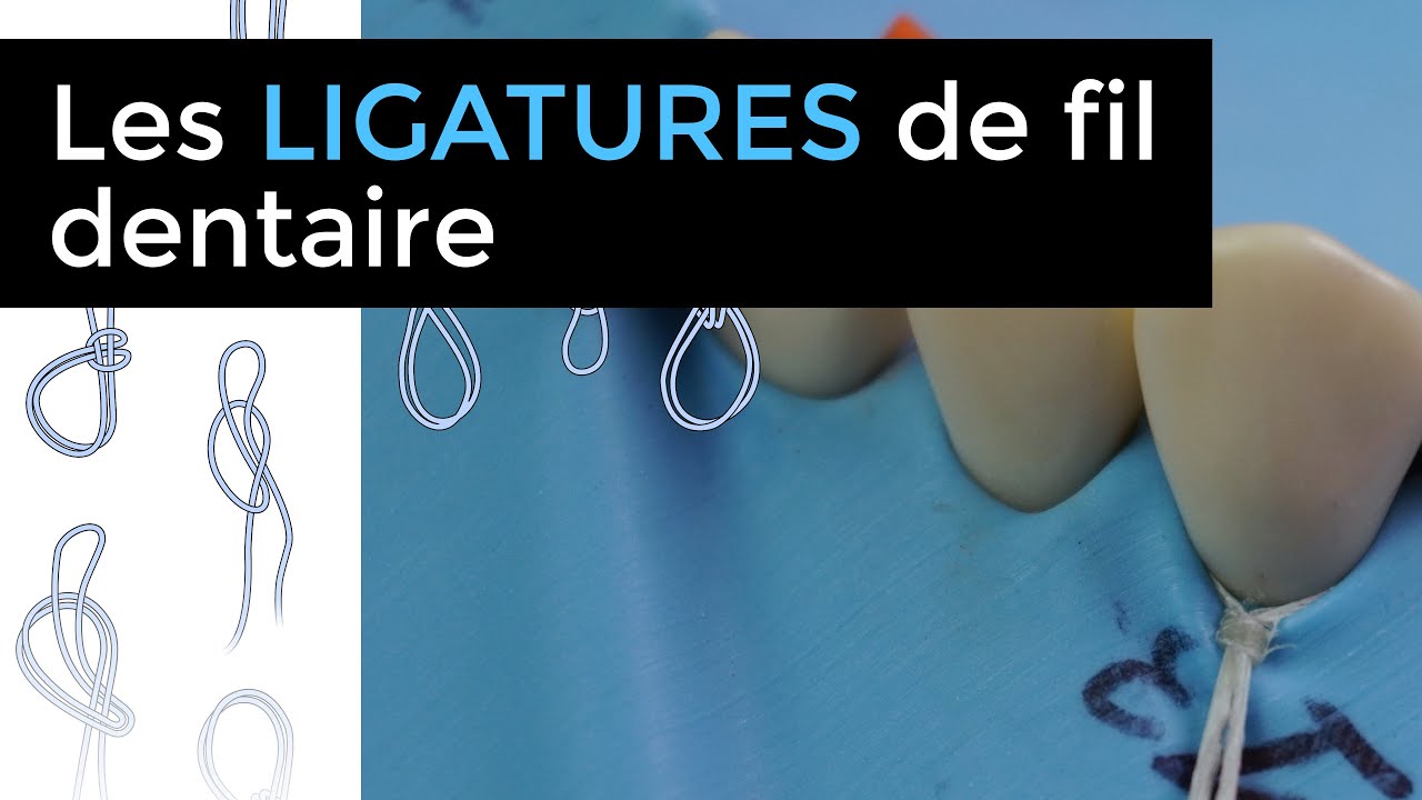 Les ligatures de fil dentaire