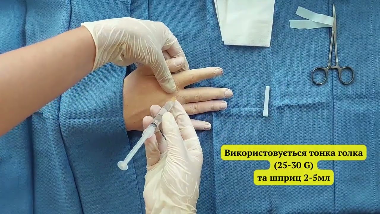 Блокада пальця з 3-х точок ( digital block anesthesia