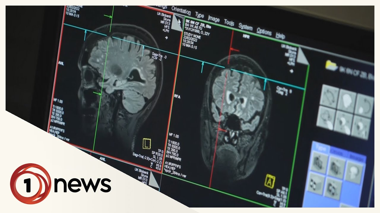 Mild Covid infection can result in 'significant' changes to the brain