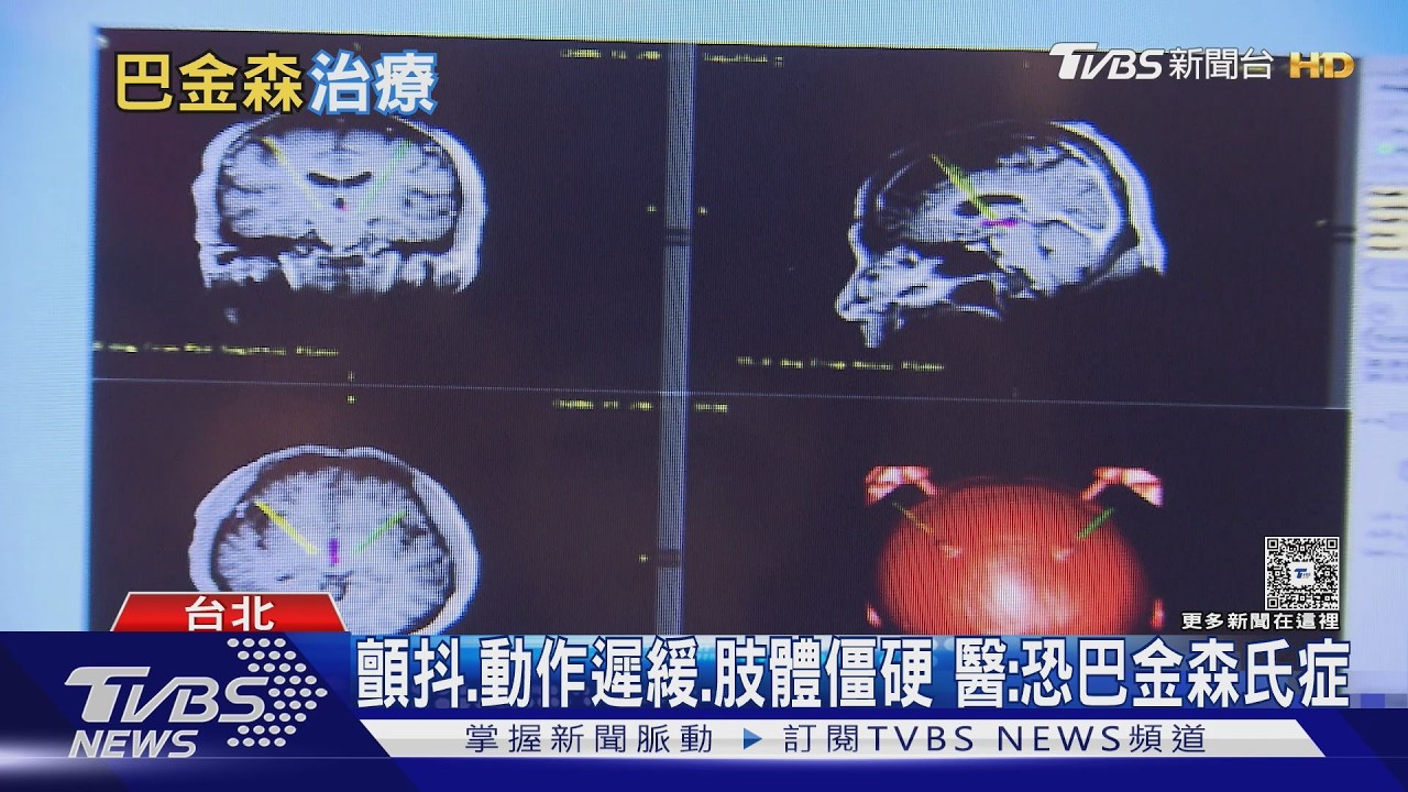 巴金森氏症不只會手抖! 醫揭4大典型症狀與治療關鍵!｜十點不一樣20260326 @tvbsnews24live