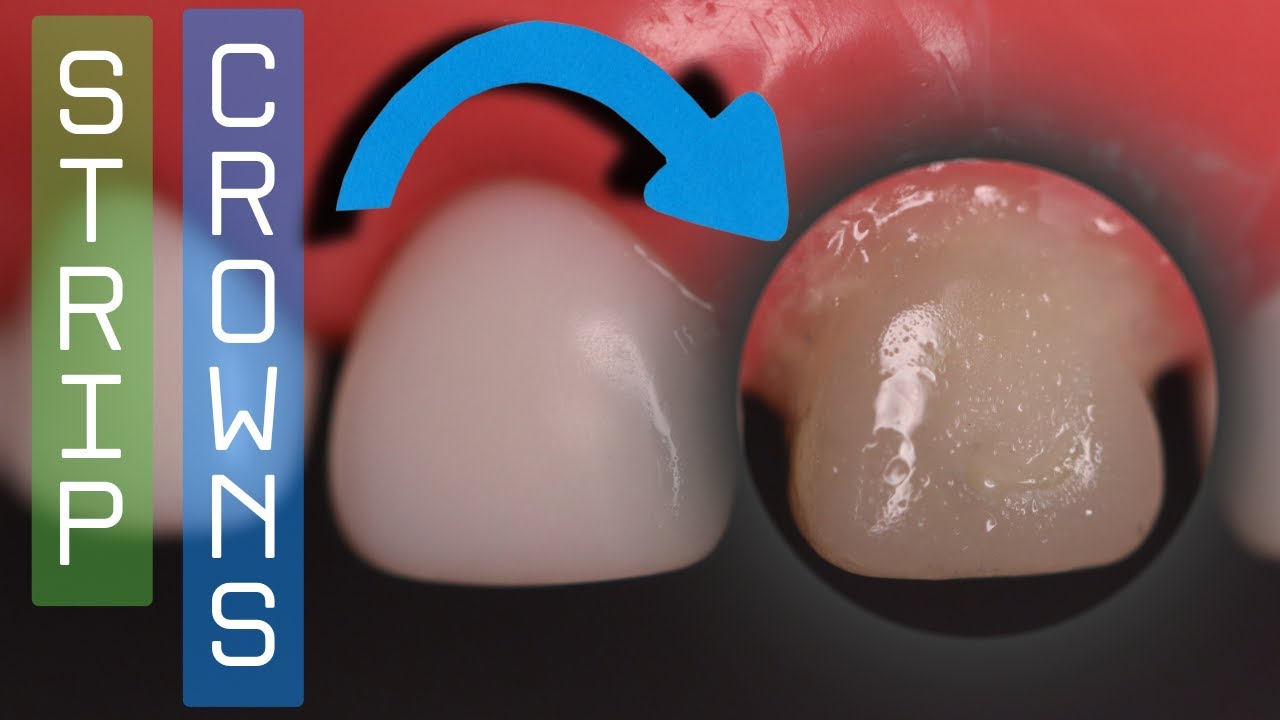 strip crowns ⚪️ step by step video 🔵