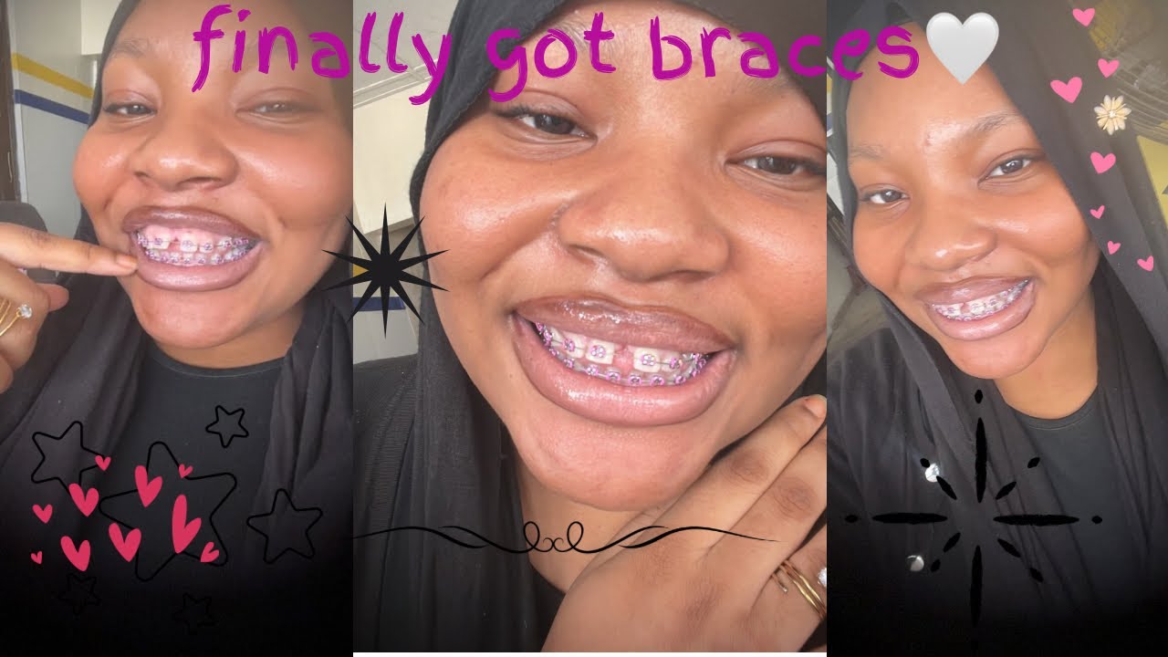 I Got Braces after years of waiting….😬🌸