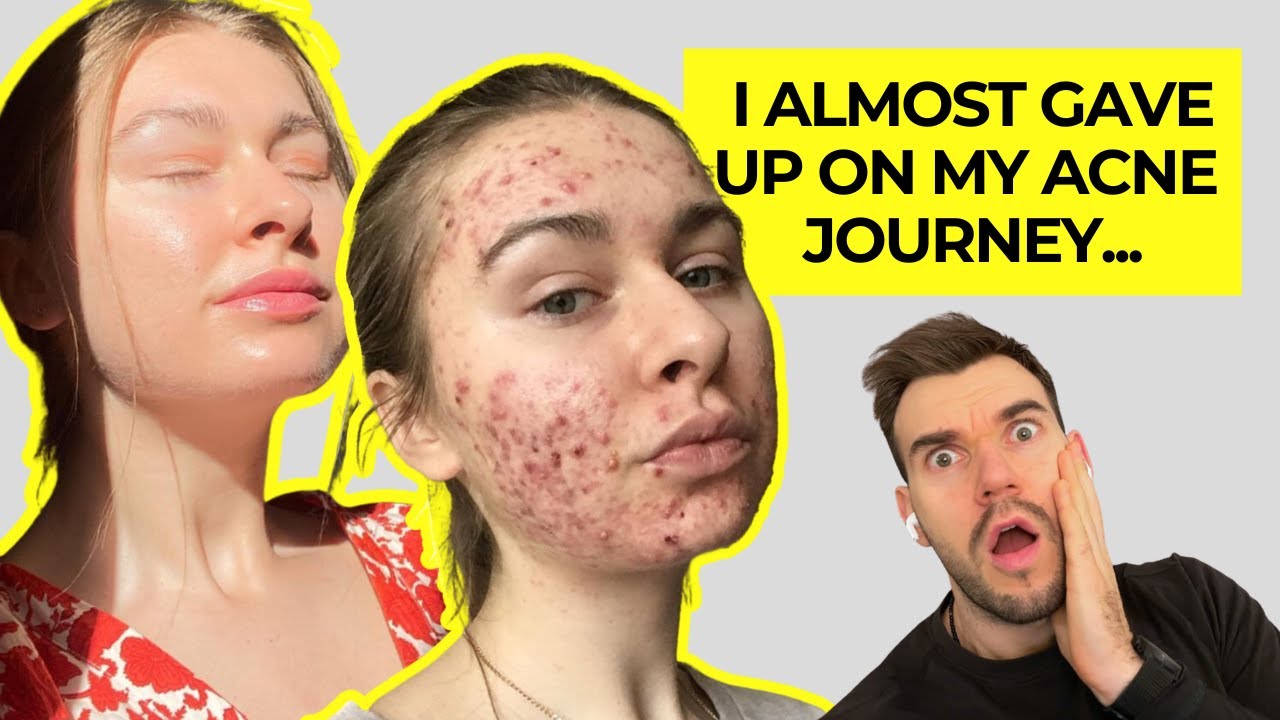 Dating With Adult Acne, Accutane, Parasite Cleansing Experiments & Skin Positivity