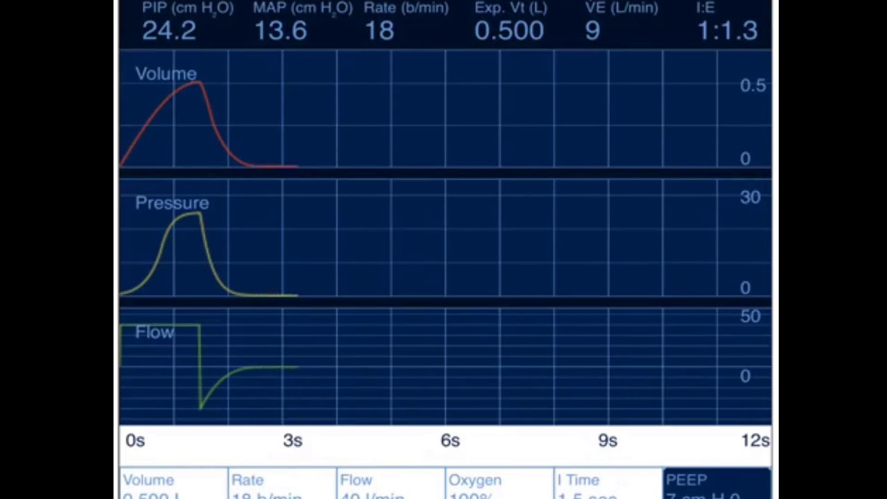 Virtual Ventilator