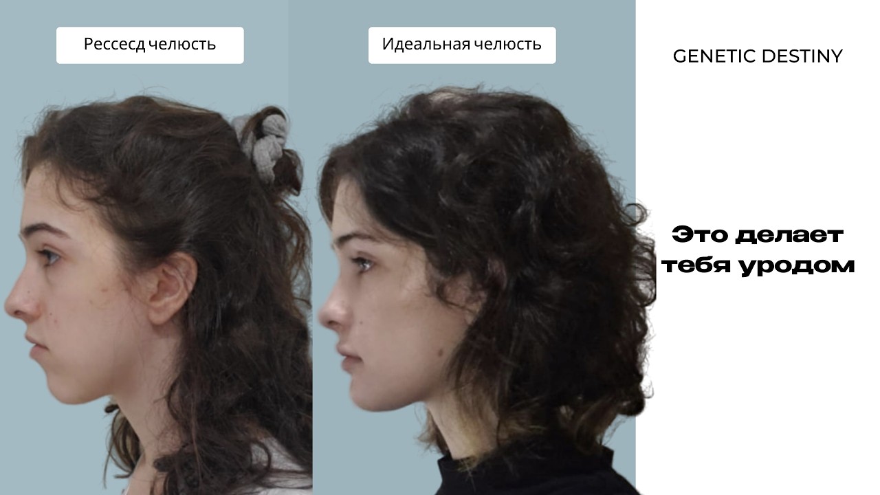 Это делает тебя некрасивым. Что такое recessed jaw/chin?