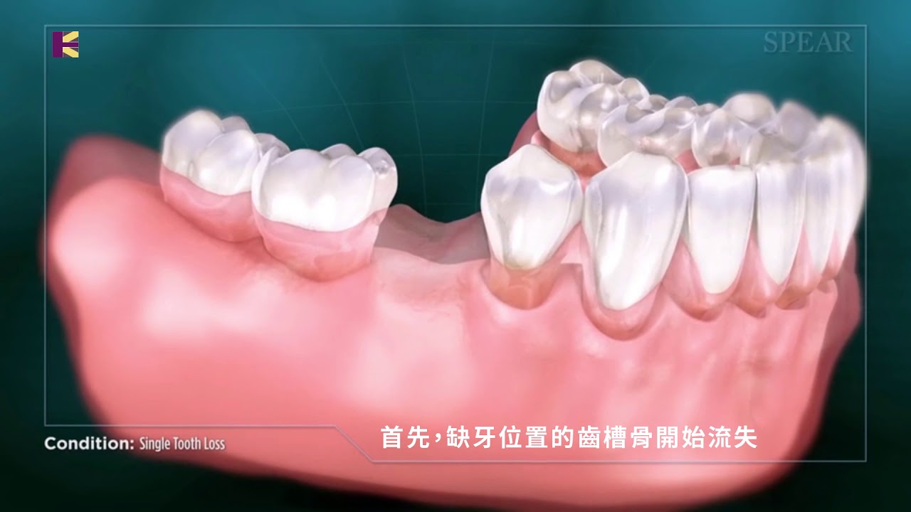 喪失單顆牙齒｜Dr. Eric Ma 馬永昌醫師