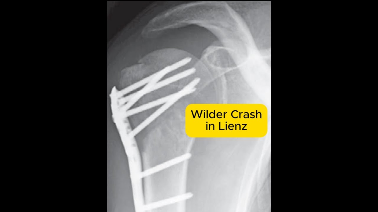 3 Meter abgestürzt und Schulter gebrochen - wilder Tag im Bikepark Lienz