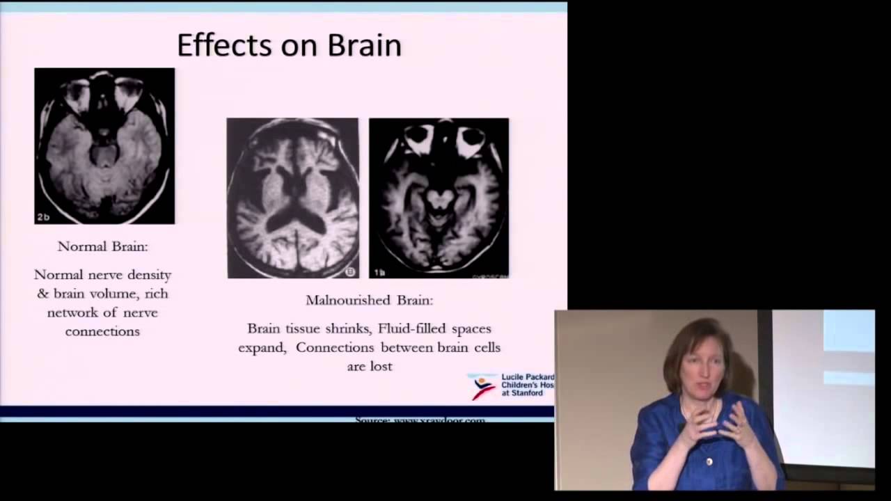 It's Time to Talk About It  Eating Disorders in Late Childhood and Preteens