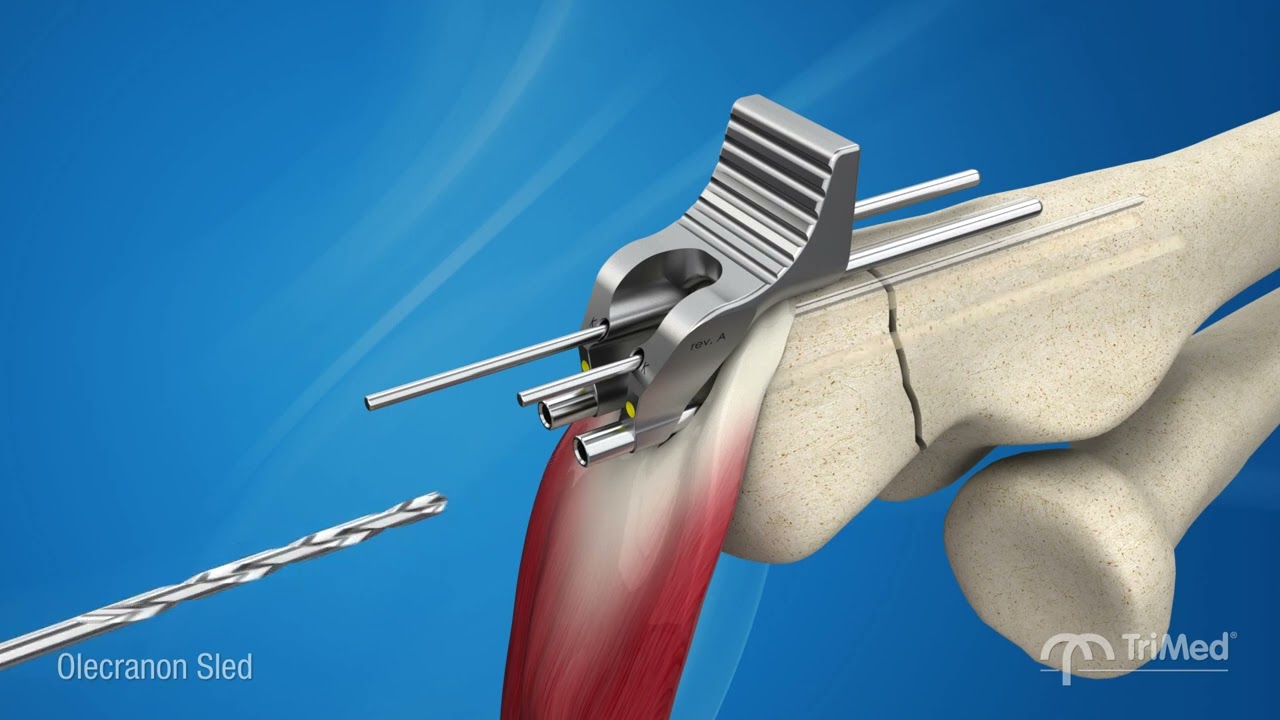 Reduce hardware removal* with TriMed's Olecranon Sled!