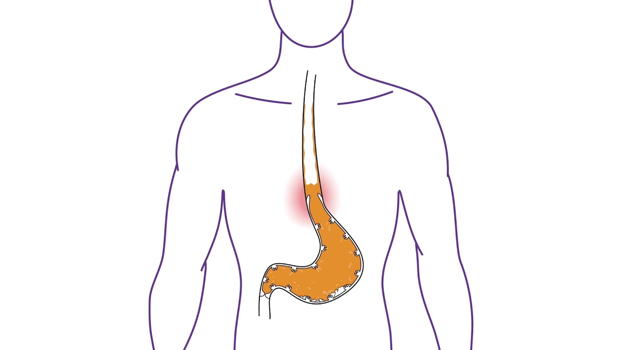 Nexium Control&reg; - What is Heartburn?