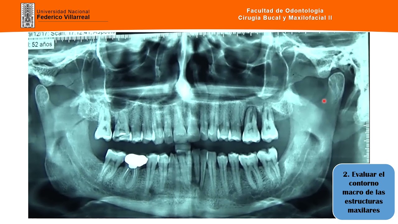 COMO LEER UNA RADIOGRAFÍA PANORÁMICA