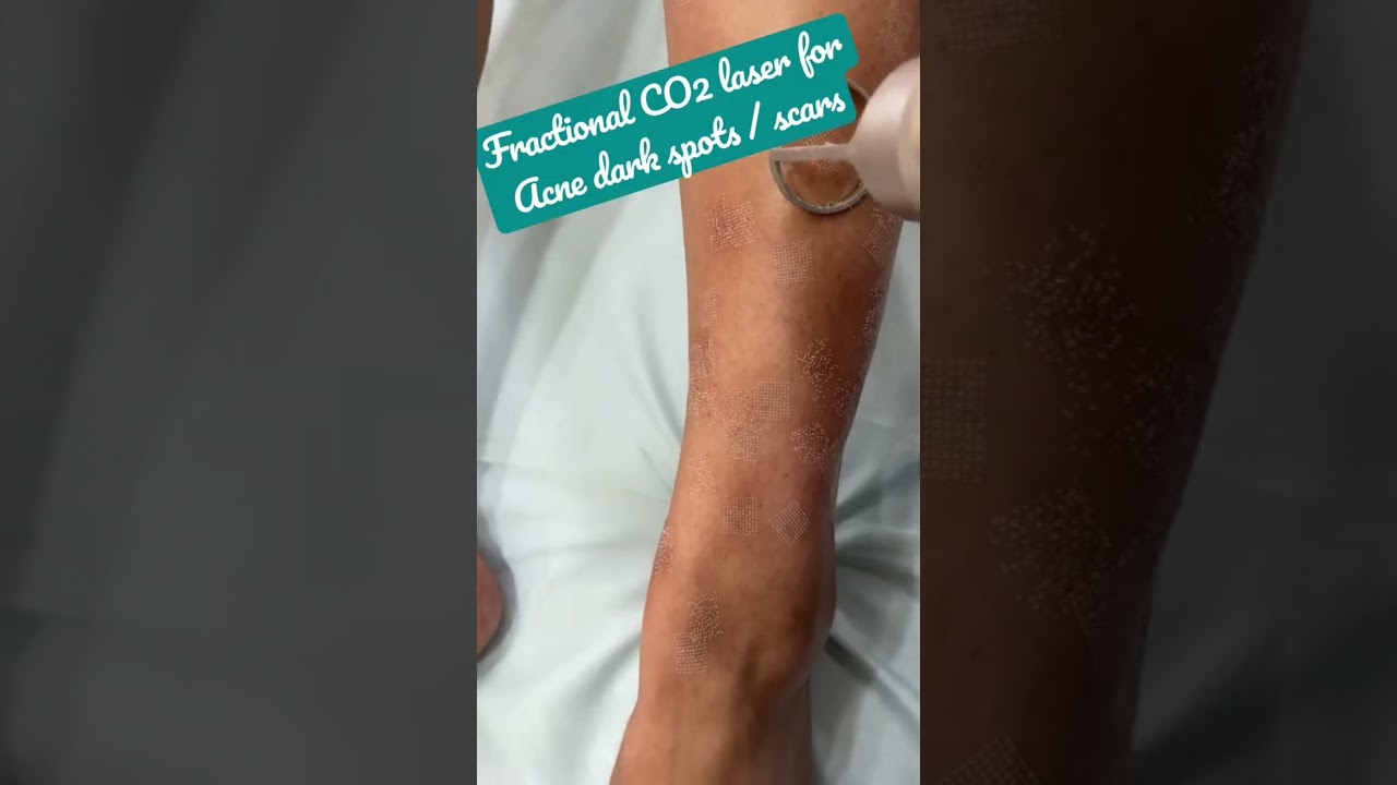 Fractional CO2laser treatment for Acne dark spots|scars|Ingrown hair legs|hormonal imbalance #shorts