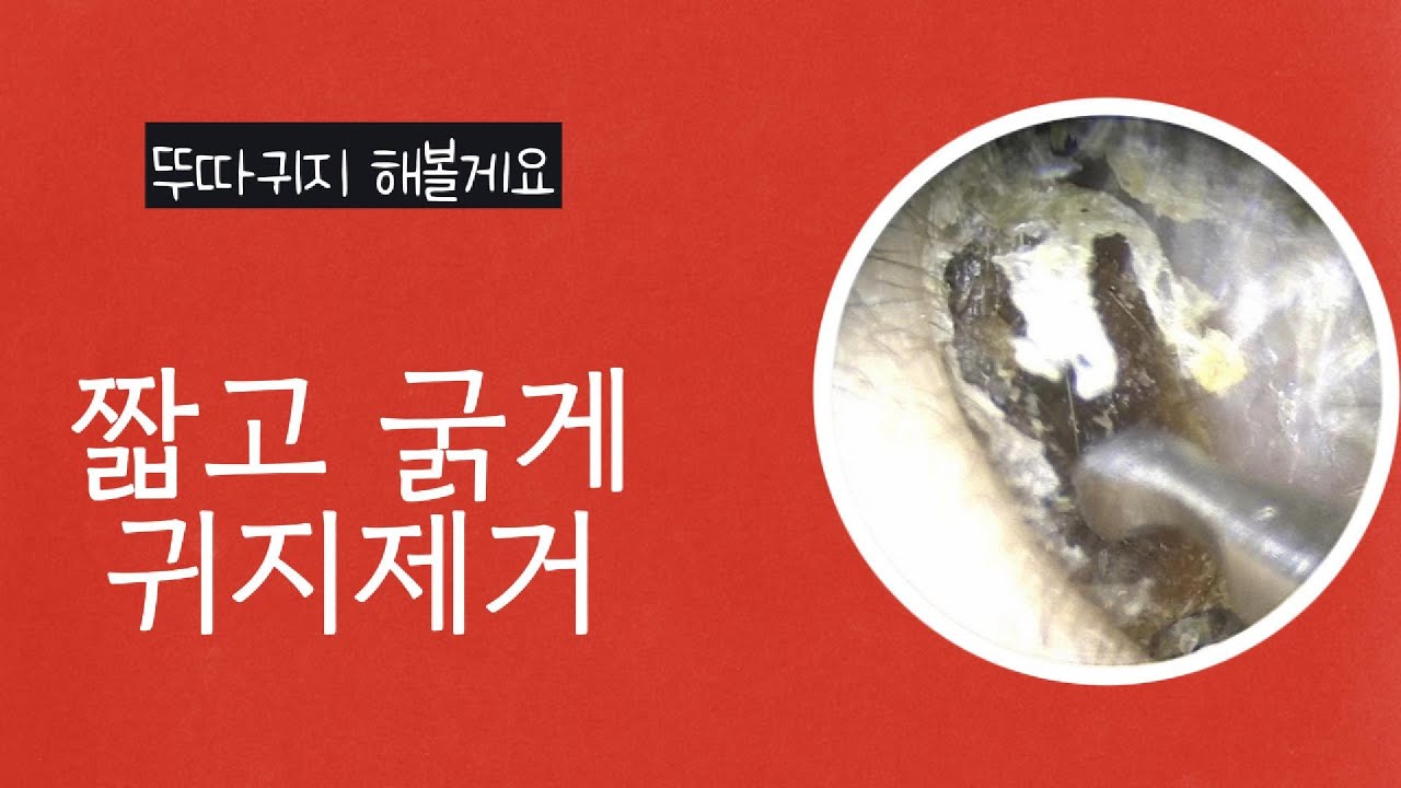 뚜따귀지 제거할게요(Earwax removal from both ears/Remo&ccedil;&atilde;o de cera dos dois ouvidos)