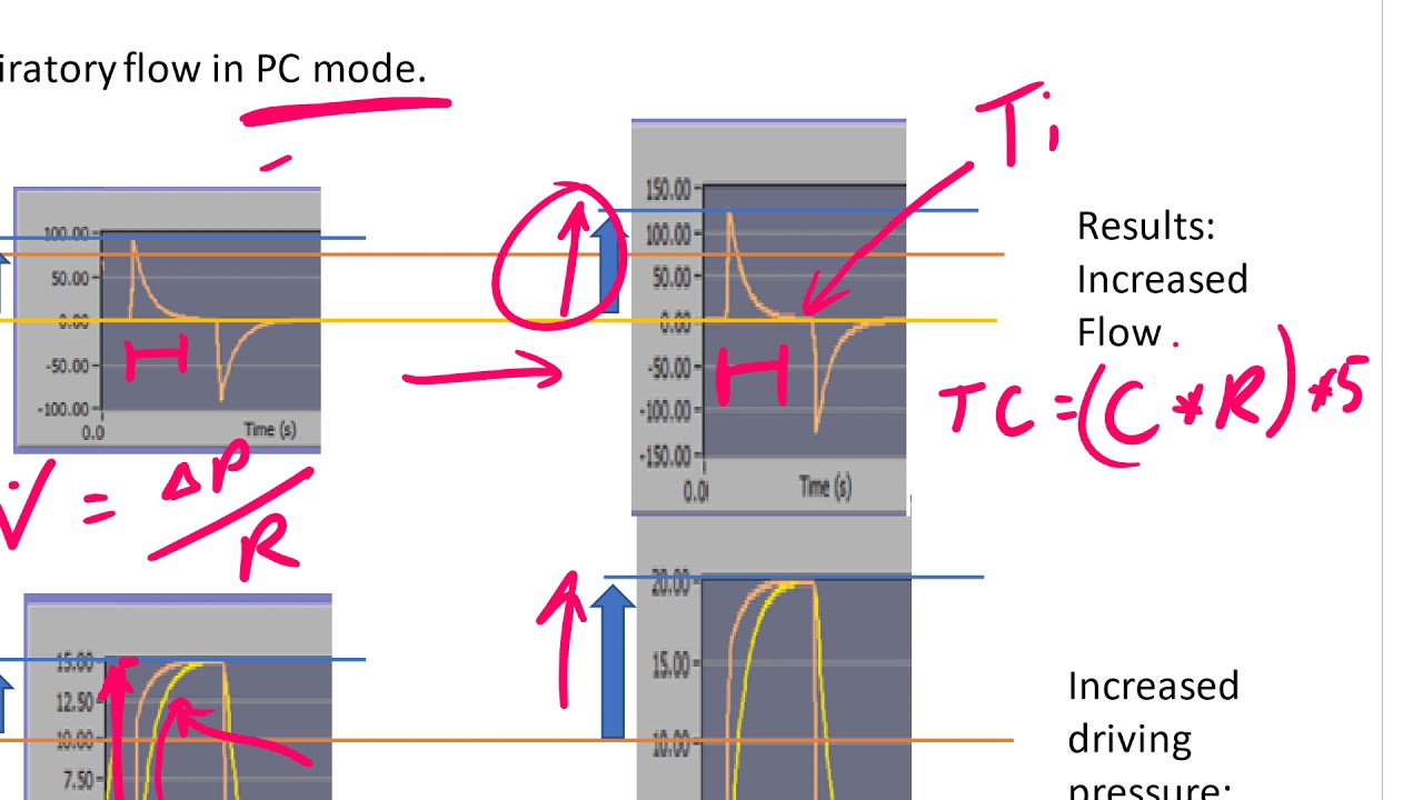 A Review of Driving Pressure with Mechanical Ventilation