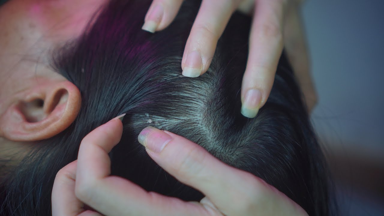 Scalp Scratch ASMR 🧠 Includes Gentle Scalp Cleaning | Hair Sounds ( Healing Session )