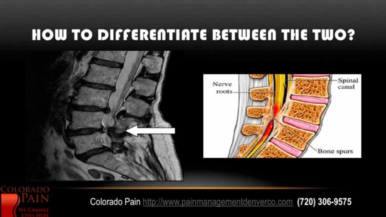 Is Your Hip Pain Caused by a Hip or Spine Problem?
