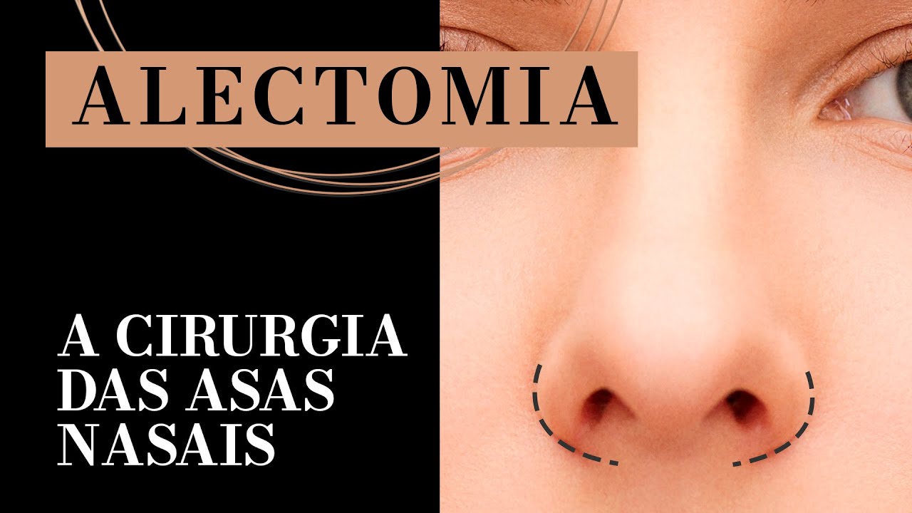 Alectomia: Redução da Asa Nasal na Rinoplastia - Dr. Fábio Maniglia
