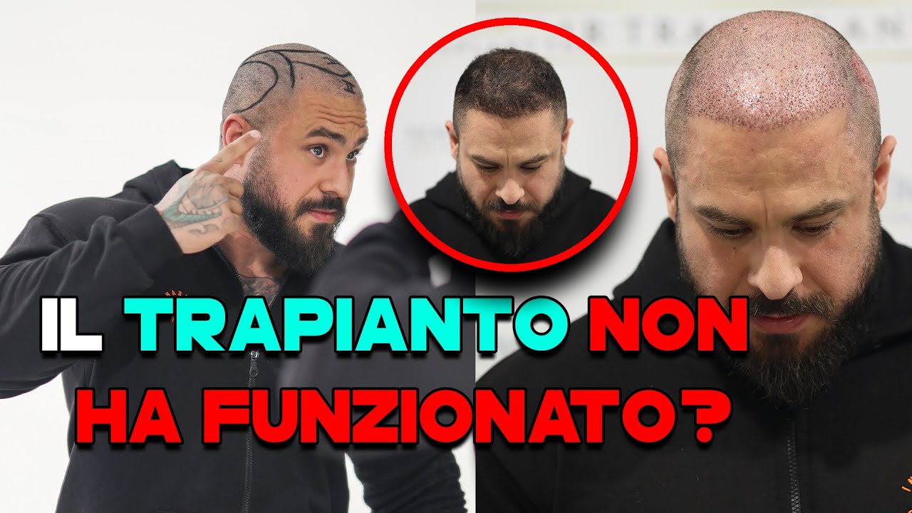 Ho rifatto il trapianto per i capelli (per la seconda volta 🤦🏻&zwj;♂️)