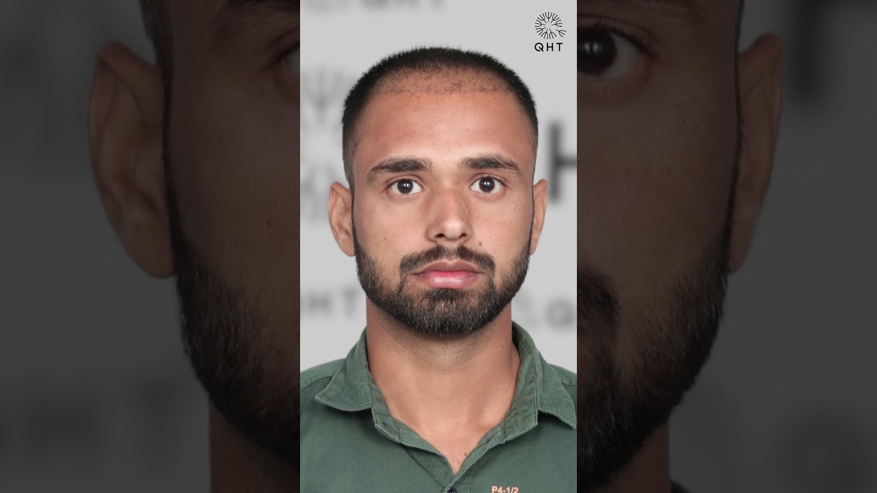 Seven Months Hair Transplant Results | Latest Fue Technique #shorts #viral #hair transplant