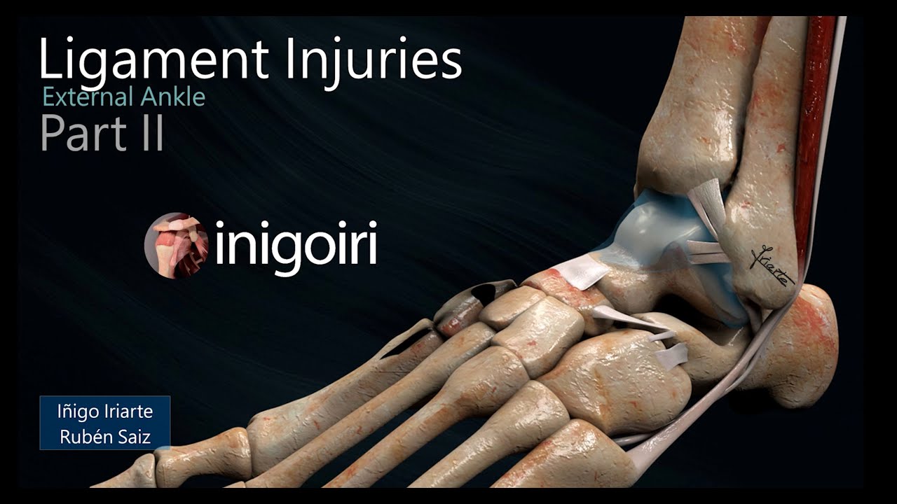 US OF LATERAL ANKLE LIGAMENT INJURIES (PART II)