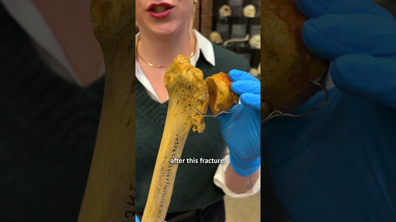 Exploring a non-union femoral neck ￼ fracture