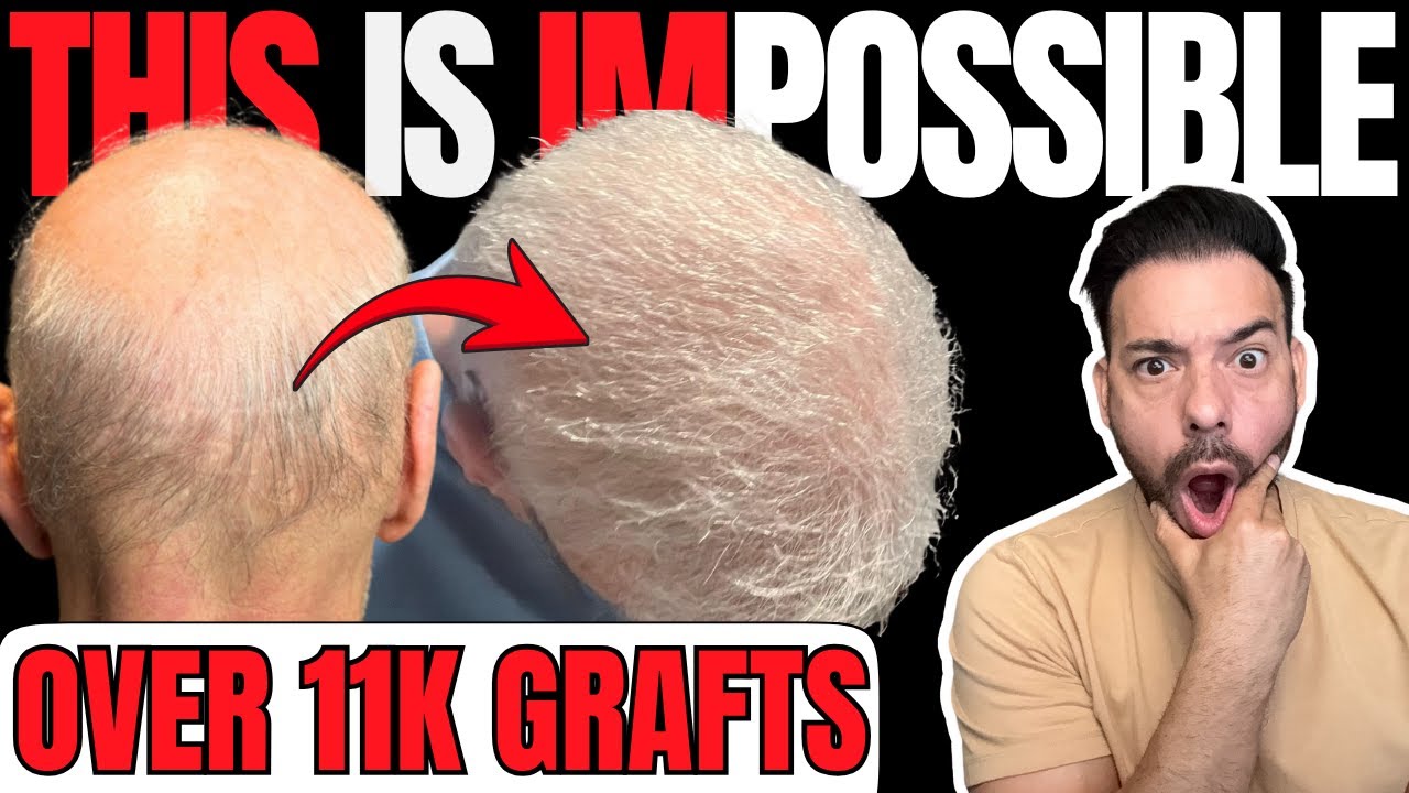 The Most IMPOSSIBLE Hair Transplant EVER! (11K Grafts)