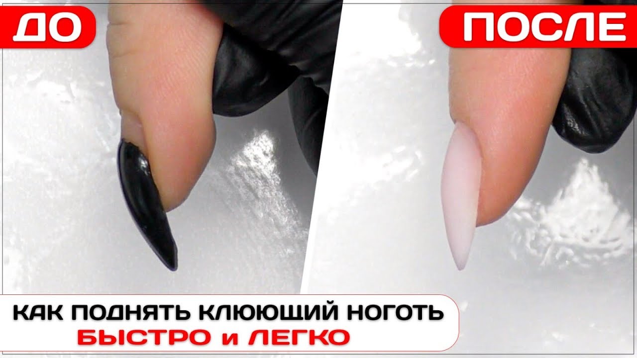 Как поднять клюющий ноготь быстро  ✅ПОЛИГЕЛЕМ наращивание миндаль ✅Наращивание ногтей акригель