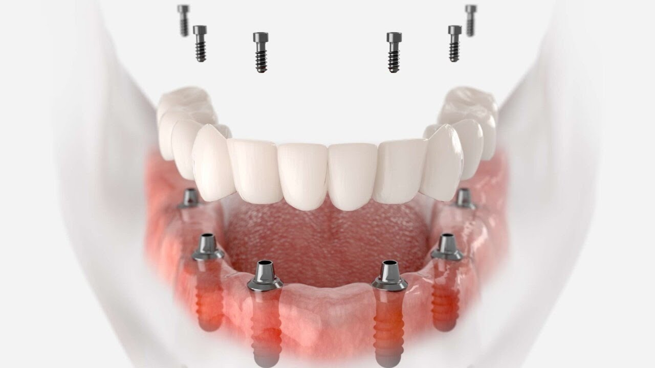 IMPLANTES DENTALES: T&Eacute;CNICAS ALL ON 4 - 6 - 8 - EL DOCTOR EN CASA TV
