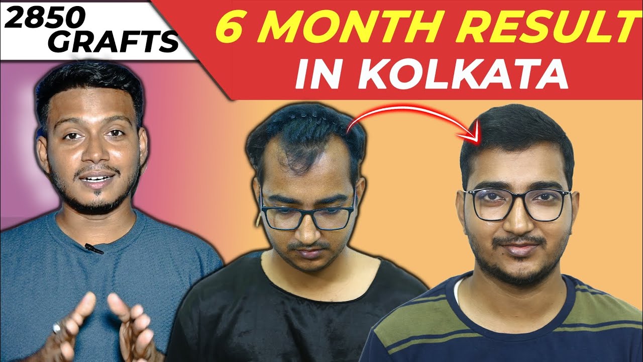 Hair transplant in kolkata || Best transplant result 2850 Grafts📍 #hairtransplant