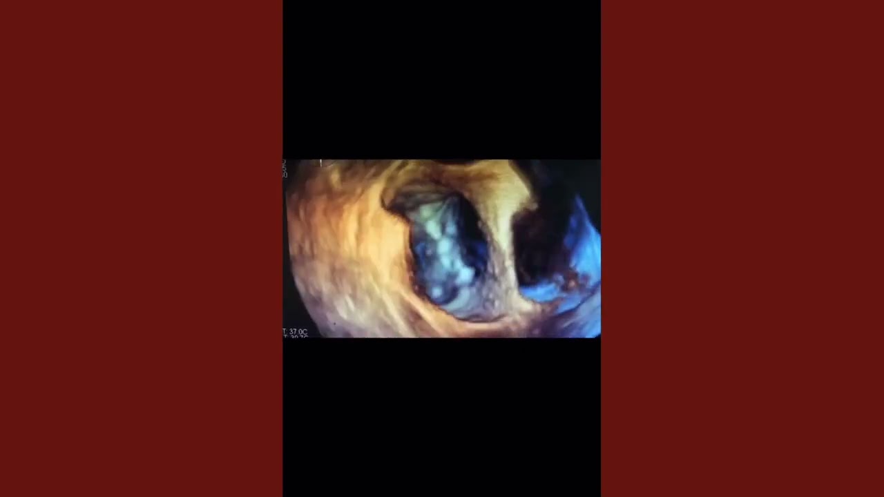 Partial AV Canal Defect with Large Ostium Primum ASD (TTE & 3D TEE)