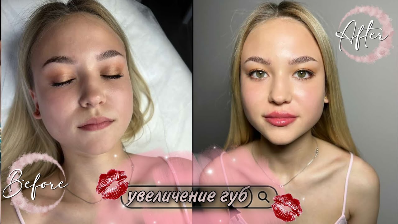 УВЕЛИЧЕНИЕ ГУБ👄ПЕРВОЕ УВЕЛИЧЕНИЕ ГУБ ВЛОГ👀РЕАКЦИЯ ПАРНЯ😮ЛЕТНИЙ ВЛОГ😏МОЕ УТРО🙂МОЙ ВЕЧЕР🤭