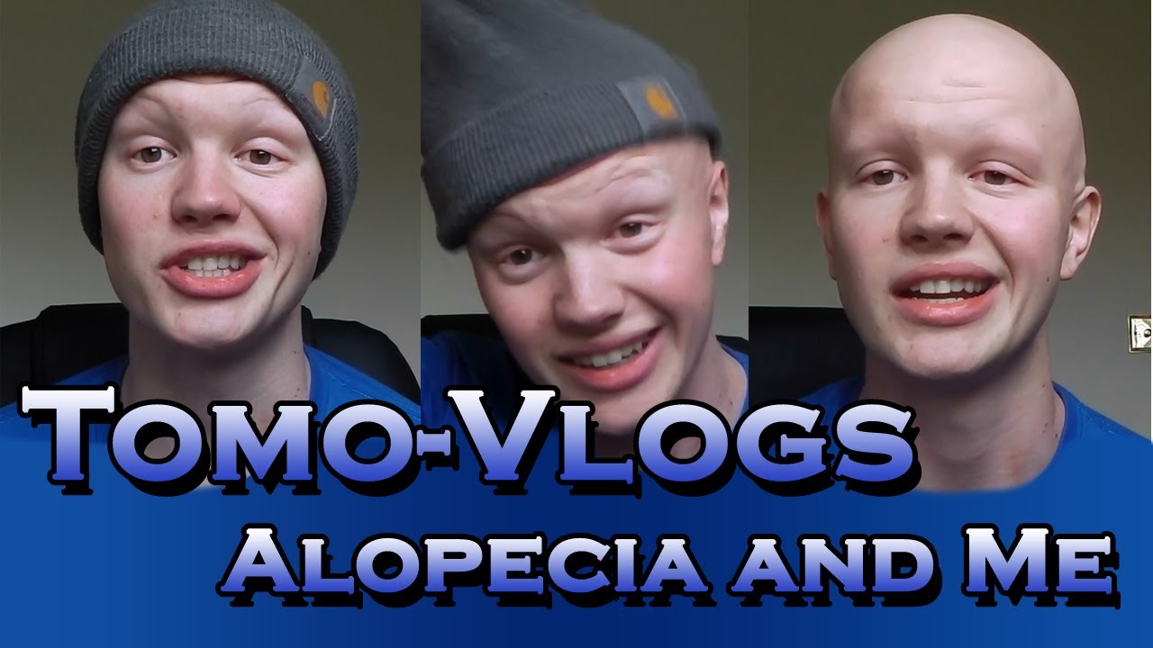 Me and Alopecia (Introduction To My Channel)
